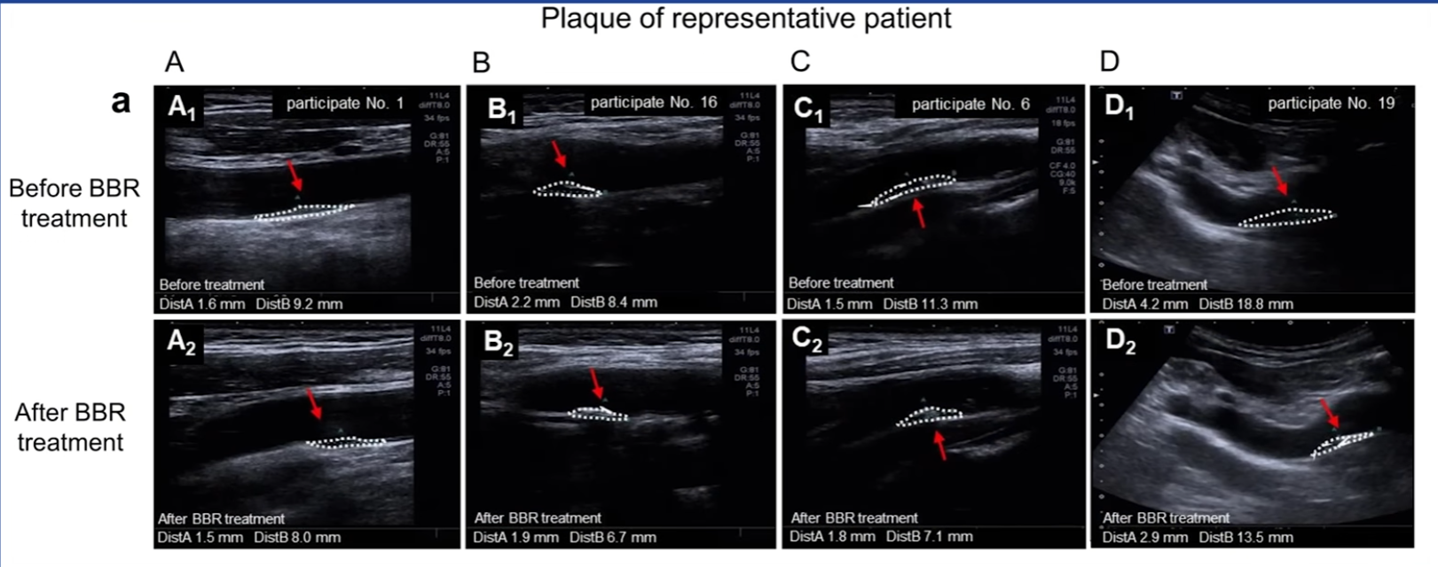 dry fasting, berberine, effect on Plaque, arteries image of plaque in artery