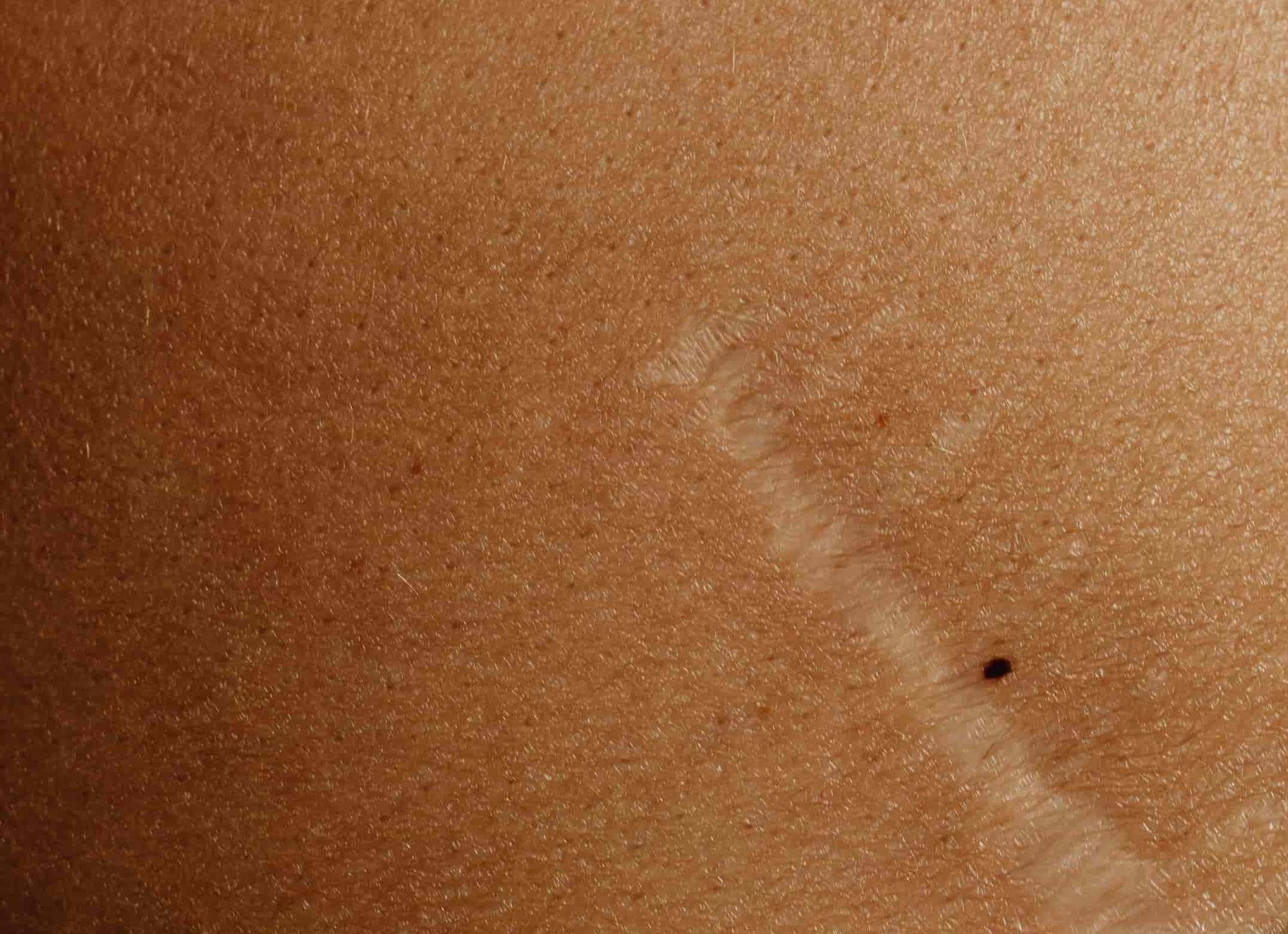 Can dry fasting heal streatch marks and loose skin - Scar