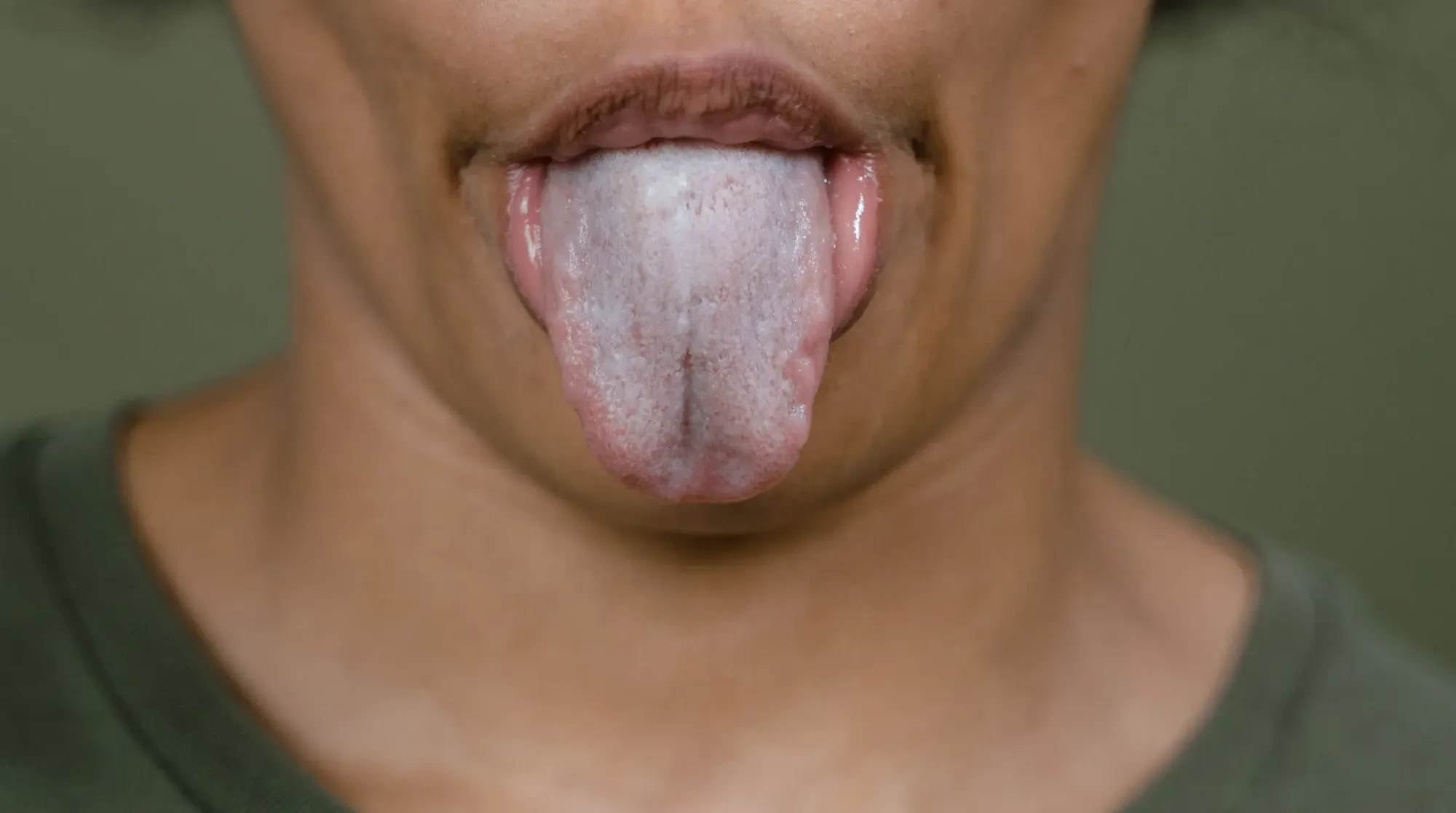 white tongue